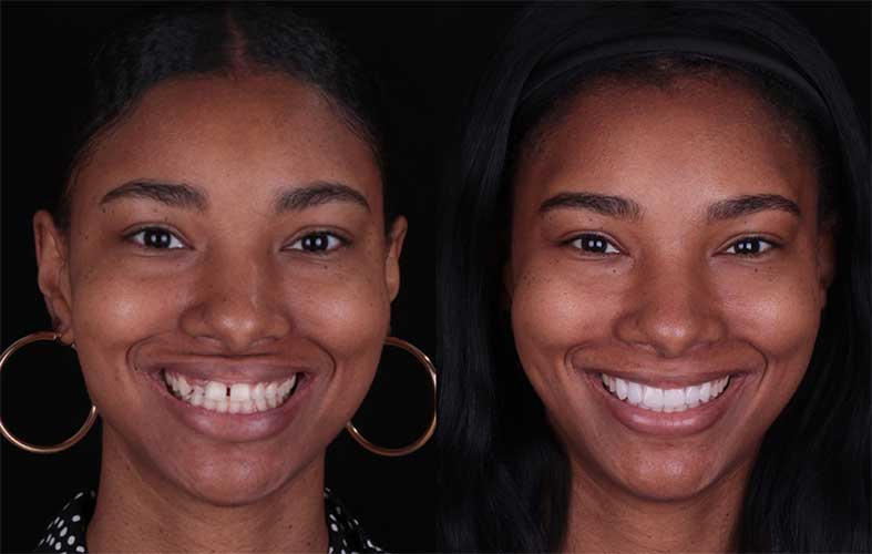 Smile makeover